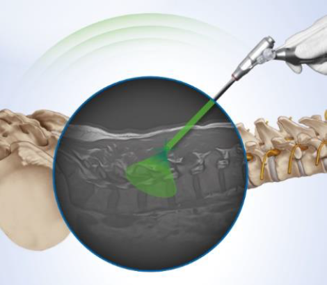 Anatomical image showing how electro-magnetic tracking and guidance allows the surgeon to visualise what’s happening during endoscopic spine surgery.