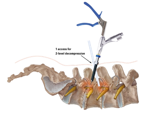 Anatomical image of instruments being used to perform endoscopic surgery of the lumbar spine